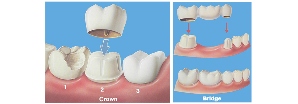 coroanele dentare